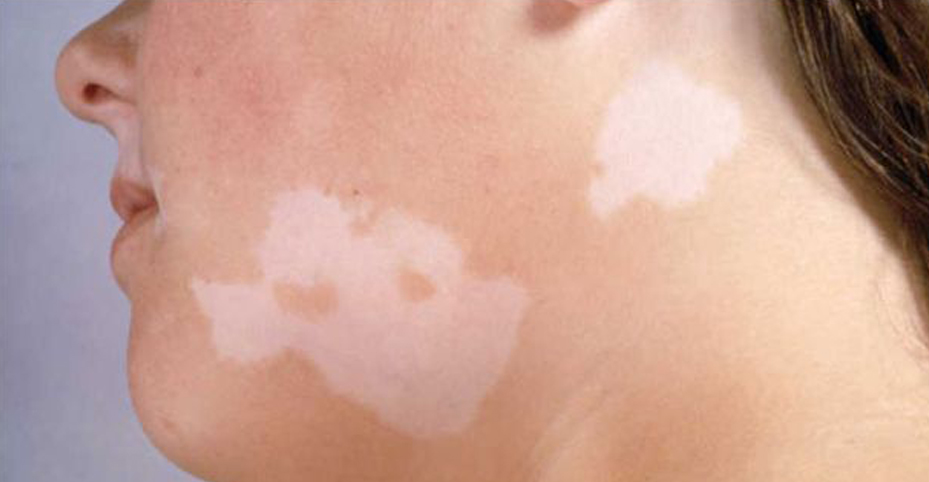 Vitiligo Surgery