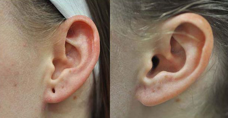 Earlobe Repair