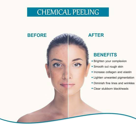 Chemical Peels